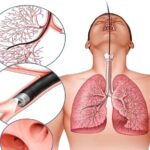 सांस नली में फांसी मूंगफली एम्स में निकली 12 दिन से परेशान थी डेढ़ साल की मासूम एम्स ने दिया नया जीवन