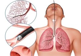 सांस नली में फांसी मूंगफली एम्स में निकली 12 दिन से परेशान थी डेढ़ साल की मासूम एम्स ने दिया नया जीवन