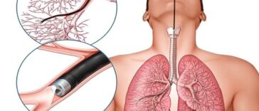 सांस नली में फांसी मूंगफली एम्स में निकली 12 दिन से परेशान थी डेढ़ साल की मासूम एम्स ने दिया नया जीवन