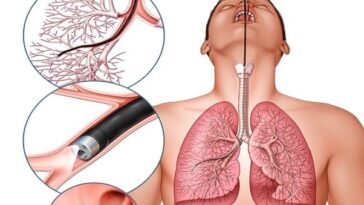 सांस नली में फांसी मूंगफली एम्स में निकली 12 दिन से परेशान थी डेढ़ साल की मासूम एम्स ने दिया नया जीवन